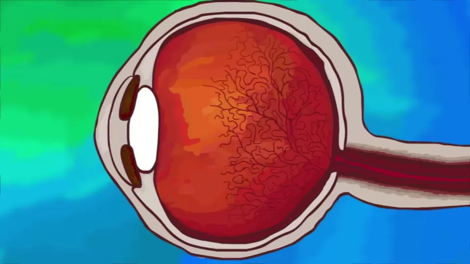 Diagram-style view of a floater casting a shadow onto the retina inside the eye